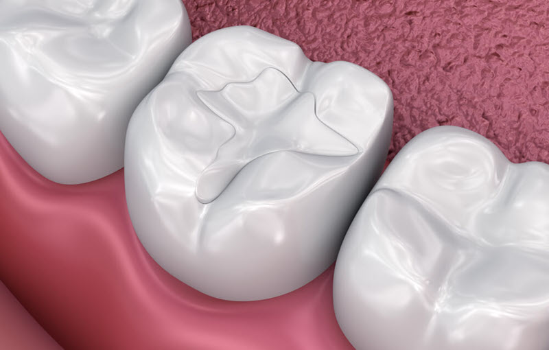 White fillings kusadasi dentist