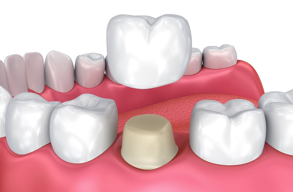 Dental-Crown-kusadasi-dentist Dental-Crown-kusadasi-dentist