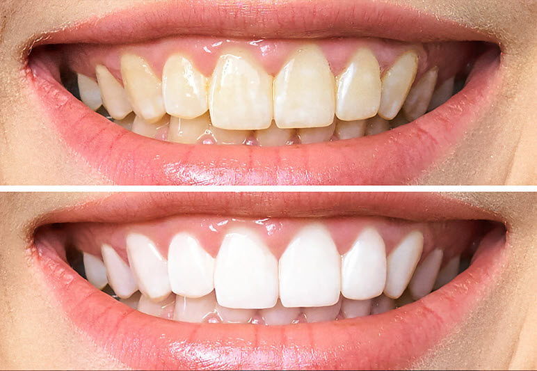 Teeth Whitening Kusadasi Dentist