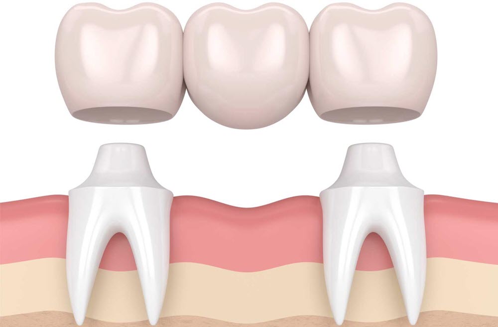 dental-bridge-kusadasi dental-bridge-kusadasi