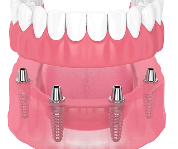 All On 4 Dental Implants