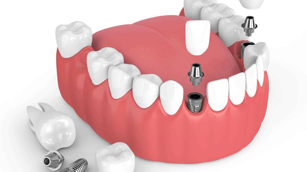 Kusadasi Dentist Implant