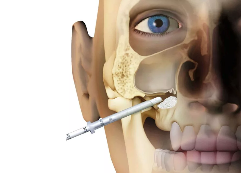 sinus lifting kusadasi dentist