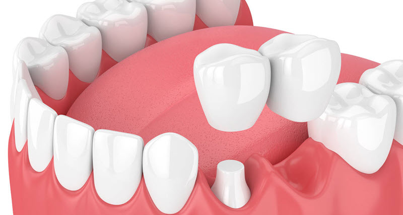 Zirconium Crown